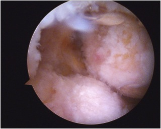 ACL PCL Deficient